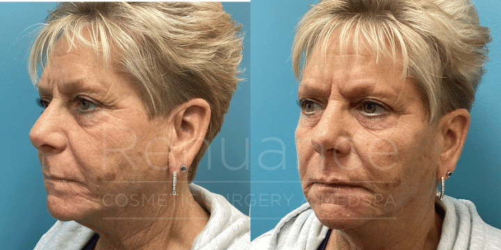 Dermal Filler