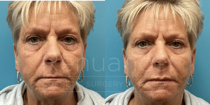 Dermal Filler