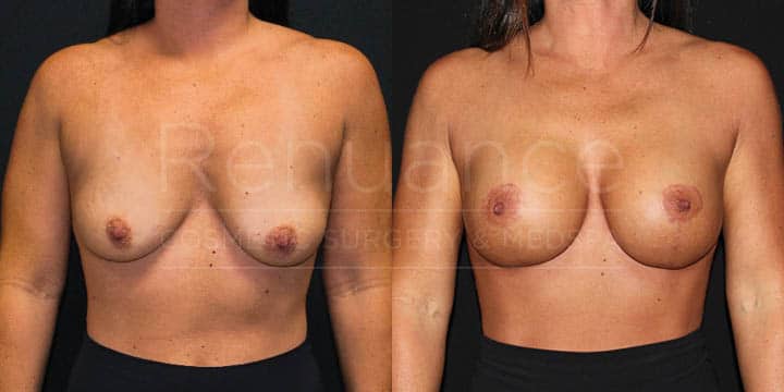 Renuance - Breast Lift and Implants by Dr Ford