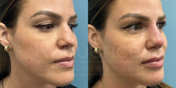 Renuance - Nose filler by Chelsea Delaney, RN