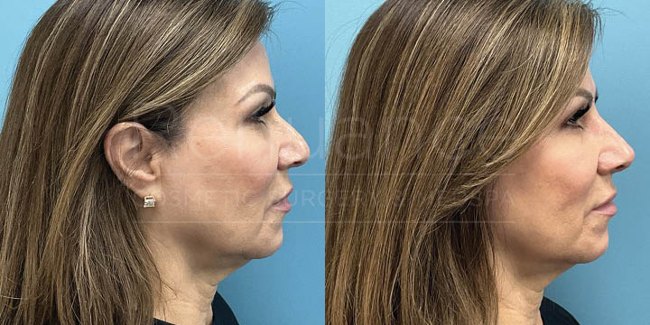 Renuance - Nose filler by Chelsea Delaney, RN