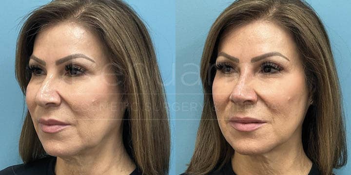 Renuance - Nose filler by Chelsea Delaney, RN