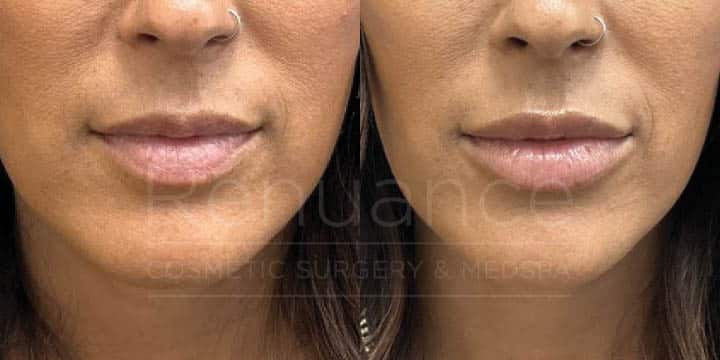 Renuance - Lip filler by Chelsea Delaney, RN