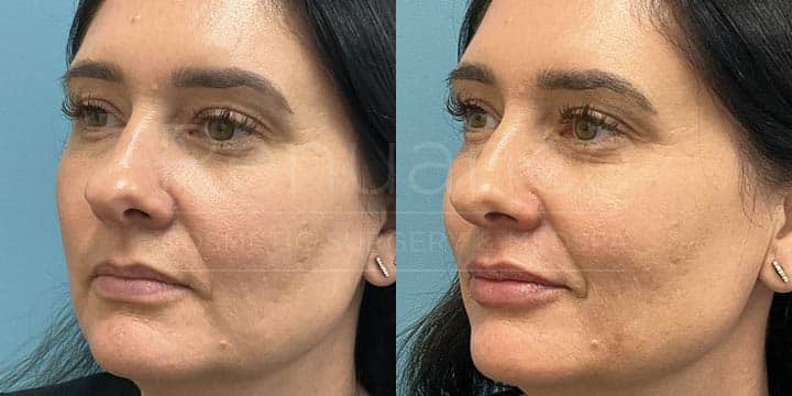 Renuance - Lip filler by Chelsea Delaney, RN
