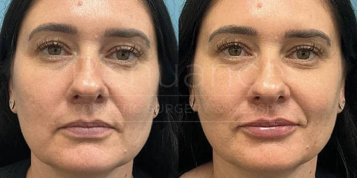 Renuance - Lip filler by Chelsea Delaney, RN