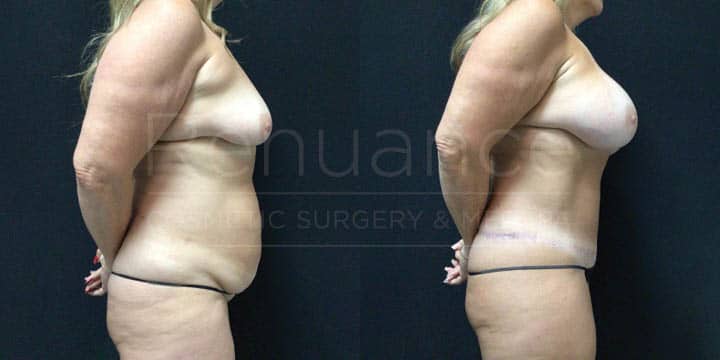 Renuance - Mommy Makeover - Tummy Tuck, Vaser360, Breast Augmentation by Michael Hill MD