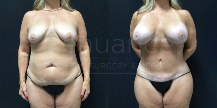 Renuance - Mommy Makeover - Tummy Tuck, Vaser360, Breast Augmentation by Michael Hill MD
