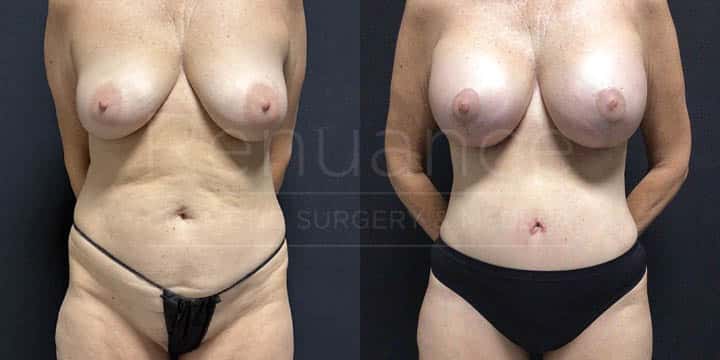 Renaunce - Mommy Makeover - Tummy Tuck, Vaser360, Breast Augmentation, Liposuction by Michael Hill MD