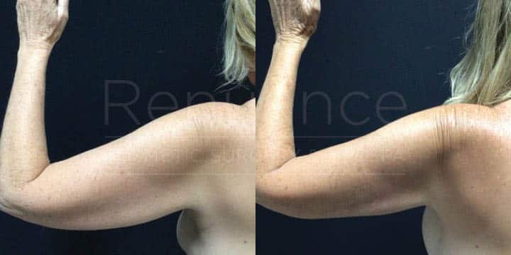 Renaunce - Mommy Makeover - Tummy Tuck, Vaser360, Breast Augmentation, Liposuction by Michael Hill MD