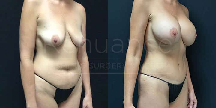 Renuance - Mommy Makeover - Tummy Tuck, Liposuction, Breast Augmentation by Michael Hill MD