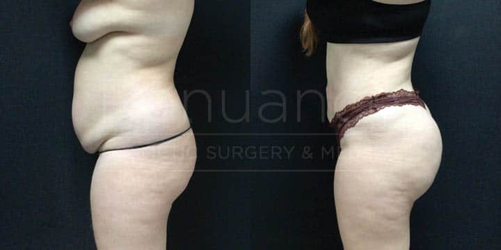 Renuance - BBL Vaser360 by Michael Hill, MD