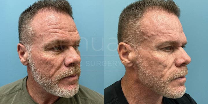 Renuance - CO2 Laser Resurfacing for men, by Michael Hill MD