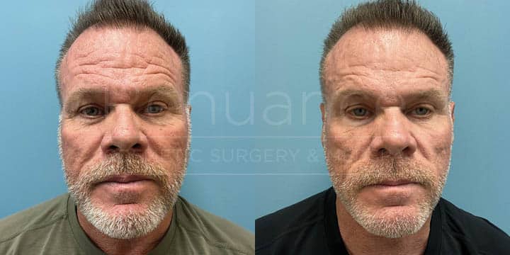 Renuance - CO2 Laser Resurfacing for men, by Michael Hill MD