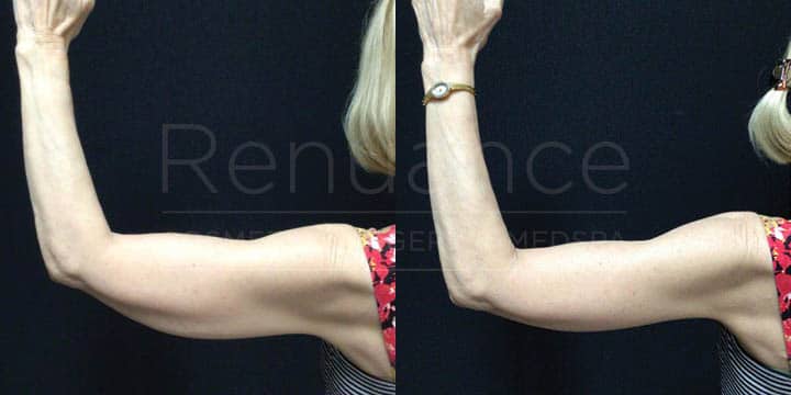 Renuance - Brachioplasty by Michael Hill, MD