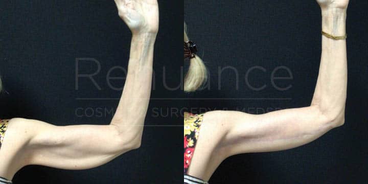 Renuance - Brachioplasty by Michael Hill, MD