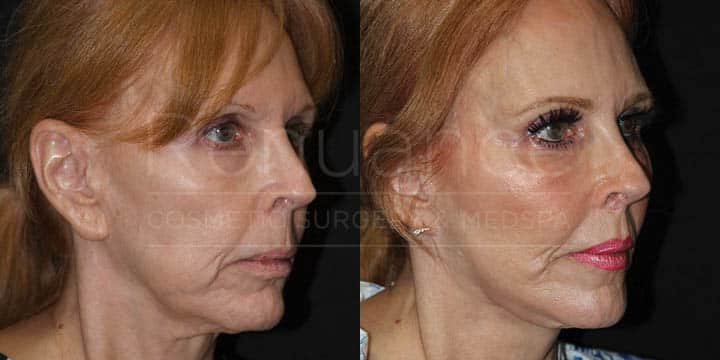 Renuance - CO2 Resurfacing, AFT, and Earlobe Reduction by Michael Hill MD