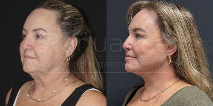 Renuance - Deep Plane Facelift, Neck Lift, Brow Lift, Fat Grafting by Michael Hill MD