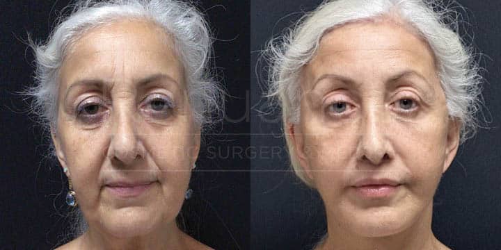 Renuance - Facelift, Neck Lift, Brow Lift, Lip Lift, Blepharoplasty, Fat Grafting by Michael Hill MD