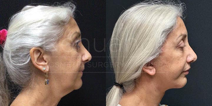 Renuance - Facelift, Neck Lift, Brow Lift, Lip Lift, Blepharoplasty, Fat Grafting by Michael Hill MD