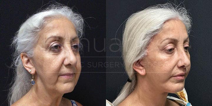 Renuance - Facelift, Neck Lift, Brow Lift, Lip Lift, Blepharoplasty, Fat Grafting by Michael Hill MD