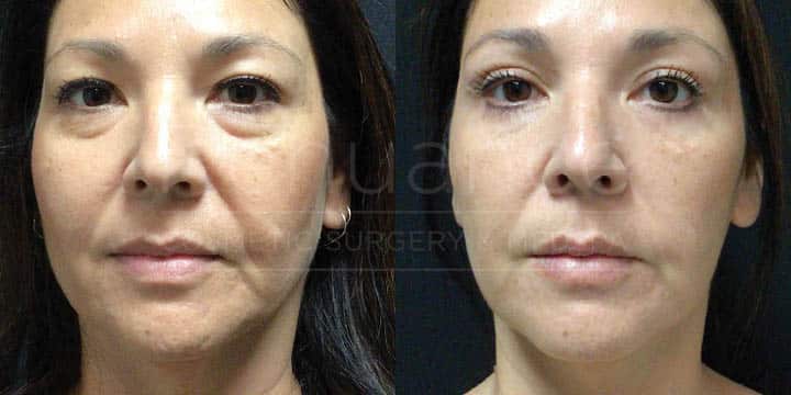Renuance - Lower Blepharoplasty by Michael Hill, MD