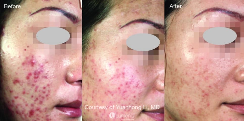 Before-and-after photos from Renuance in Murrieta showing a patient’s skin improvement after M22 acne laser treatment, with reduced redness and clearer texture.