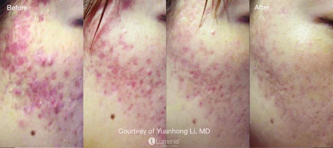 Side-by-side comparison photos from Renuance in Murrieta showing a patient’s skin before and after acne laser treatment, with visible reduction in redness and blemishes.