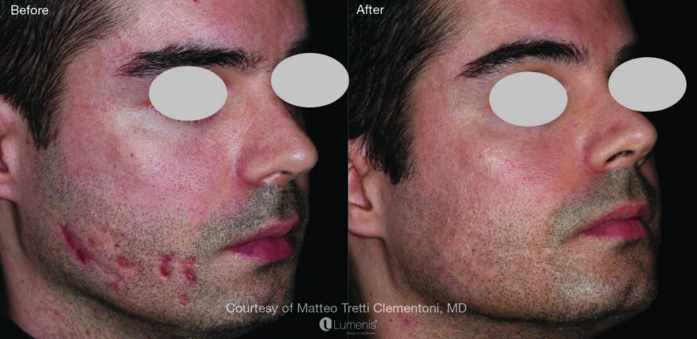 skin texture before and after laser treatment