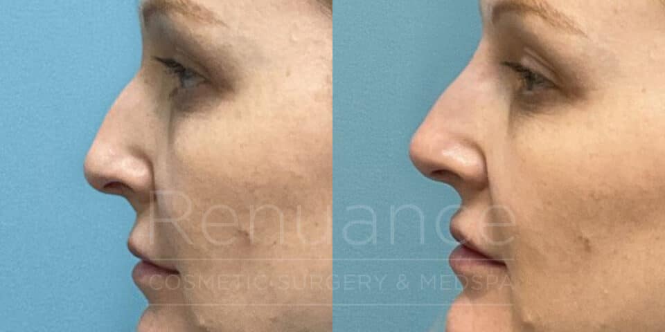 before and after liquid rhinoplasty