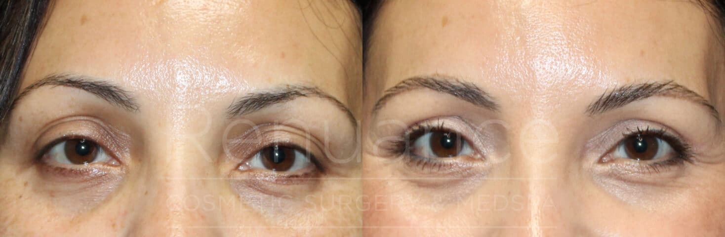 blepharoplasty before and after