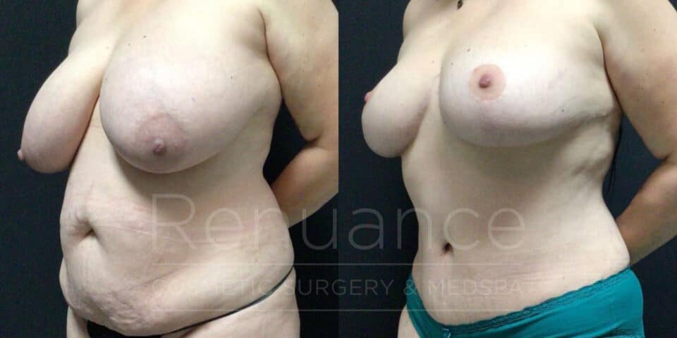 before and after breast reduction