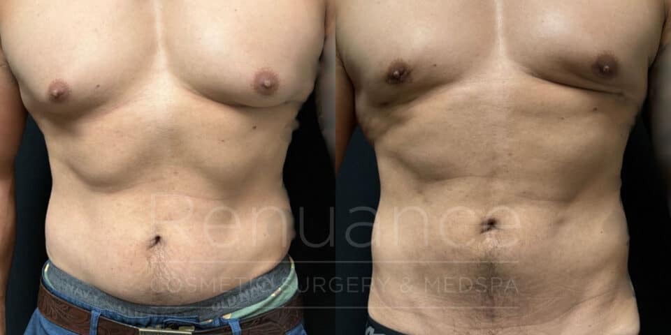 before and after gynecomastia