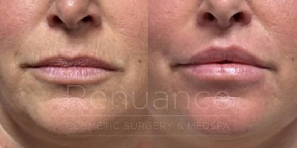 lip lift and fat transfer