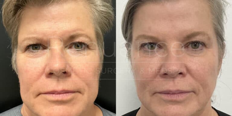 Renuance before and after | Botox/Radiesse injectables by Deborah Taurek, MD.