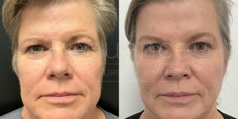 botox before and after and radiesse