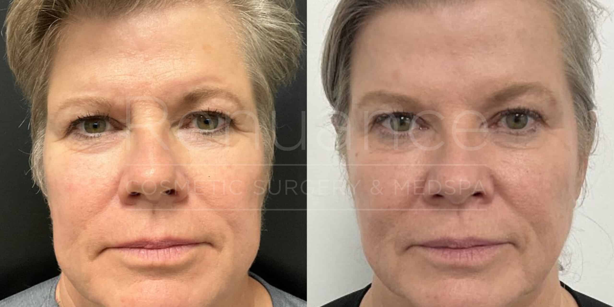 Renuance before and after | Botox/Radiesse injectables by Deborah Taurek, MD.