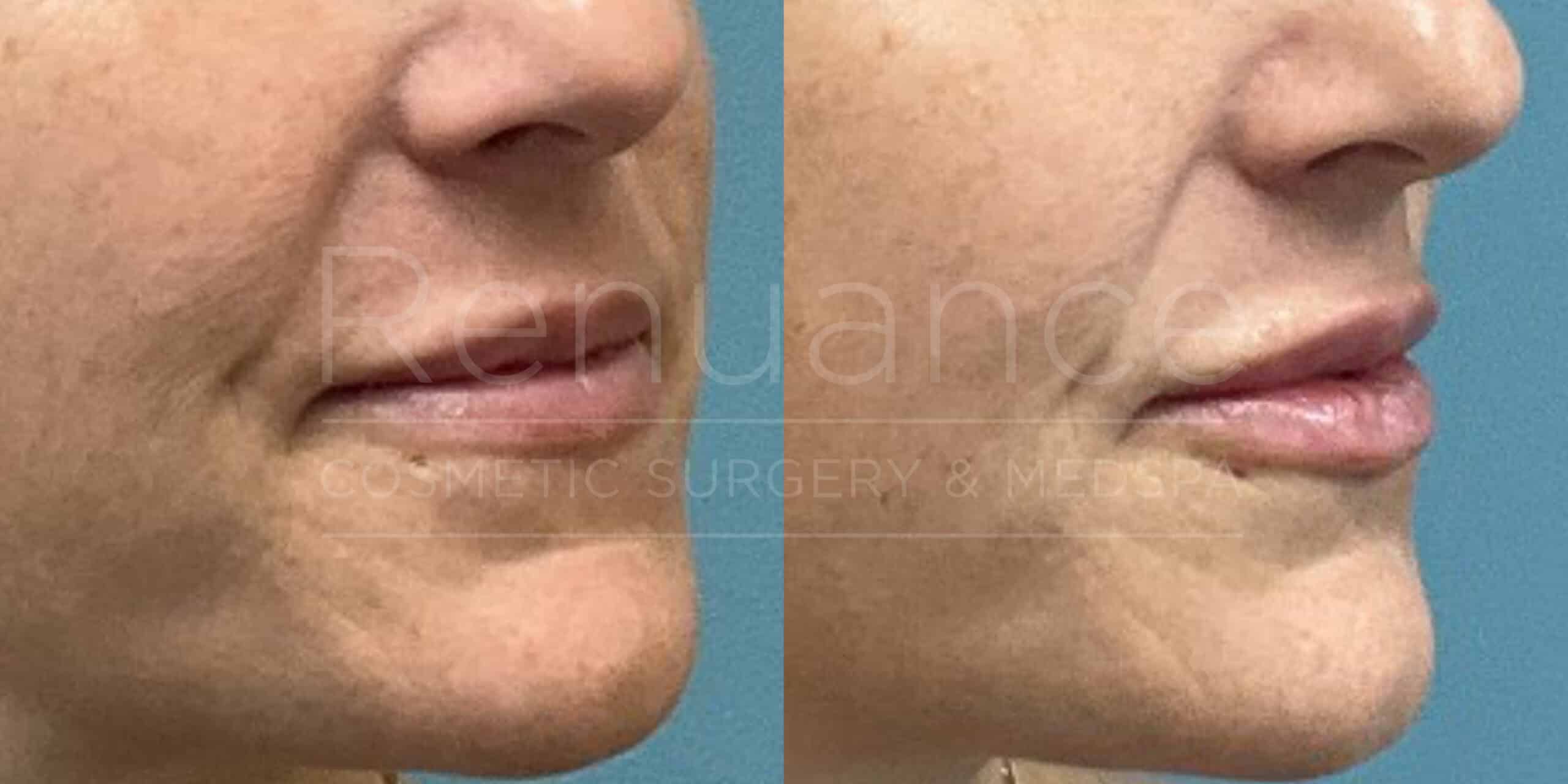 Renuance before and after | Lip filler by Deborah Taurek, MD.