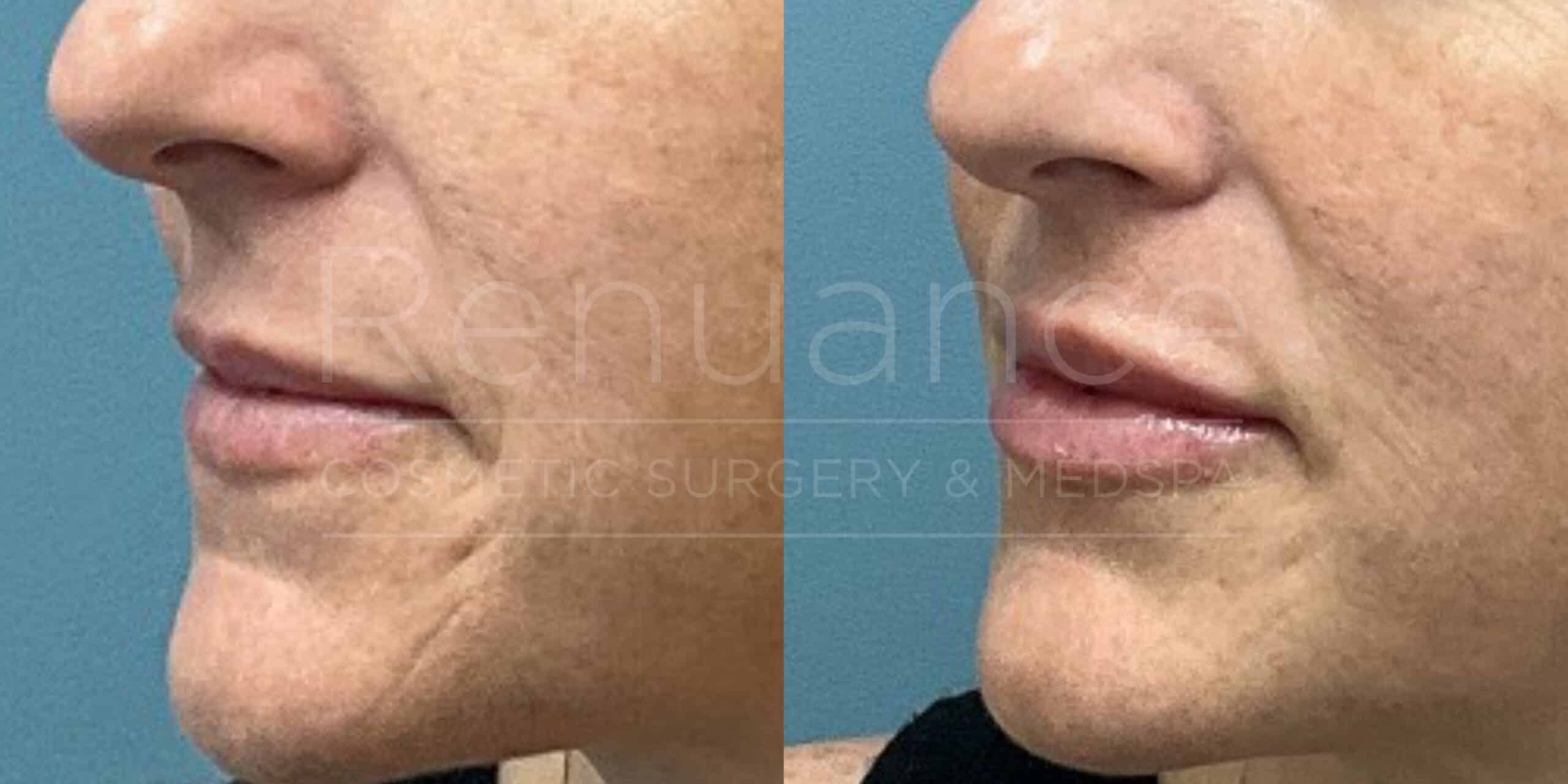 Renuance before and after | Lip filler by Deborah Taurek, MD.
