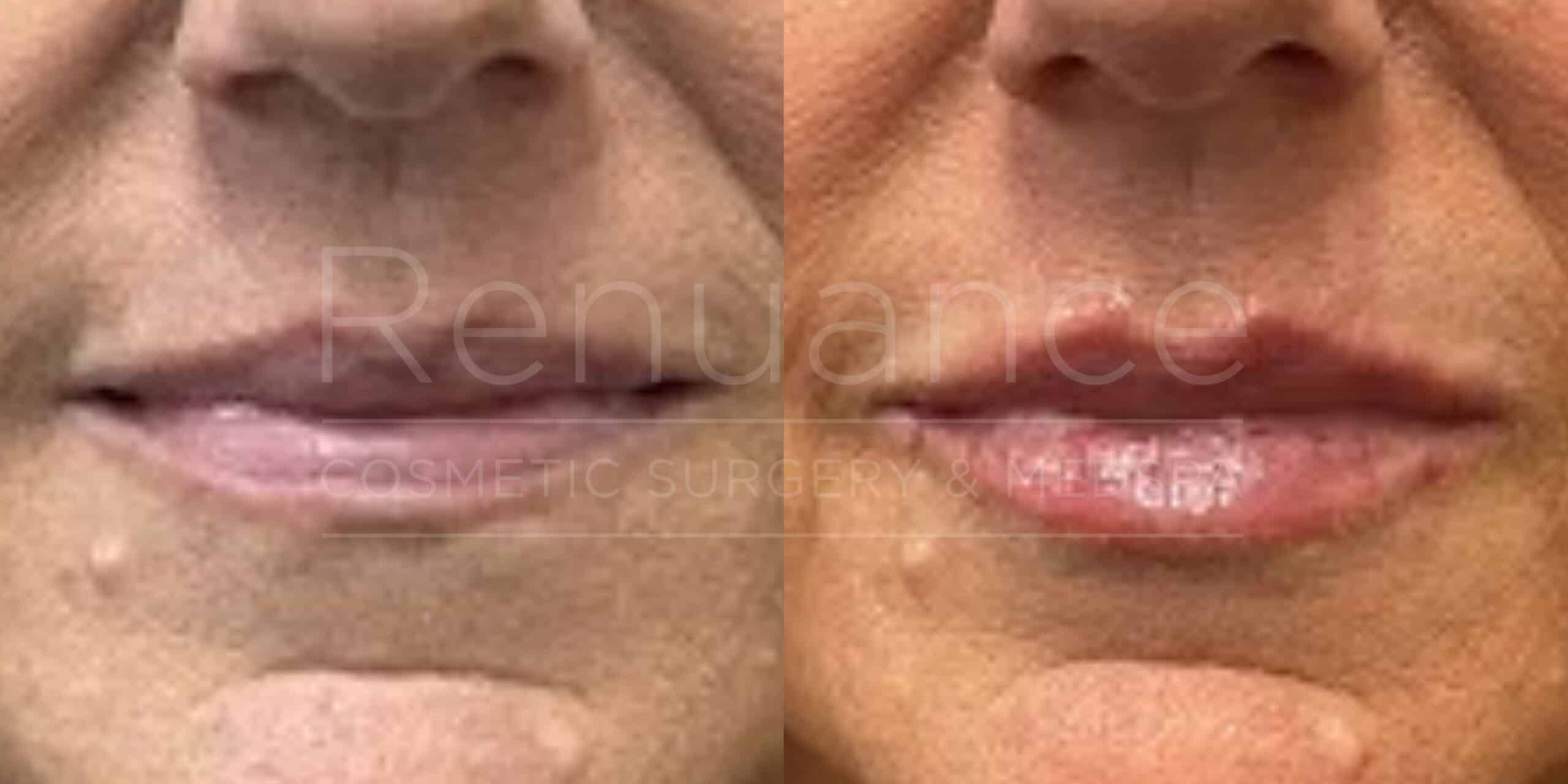 Renuance before and after | Lip filler by Chelsea Delaney, RN.