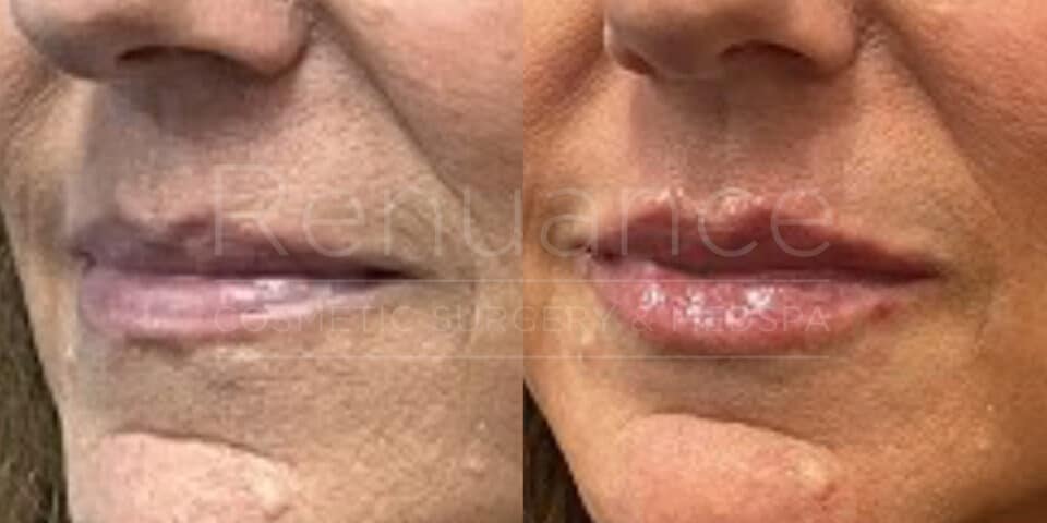 Renuance before and after | Lip filler by Chelsea Delaney, RN.