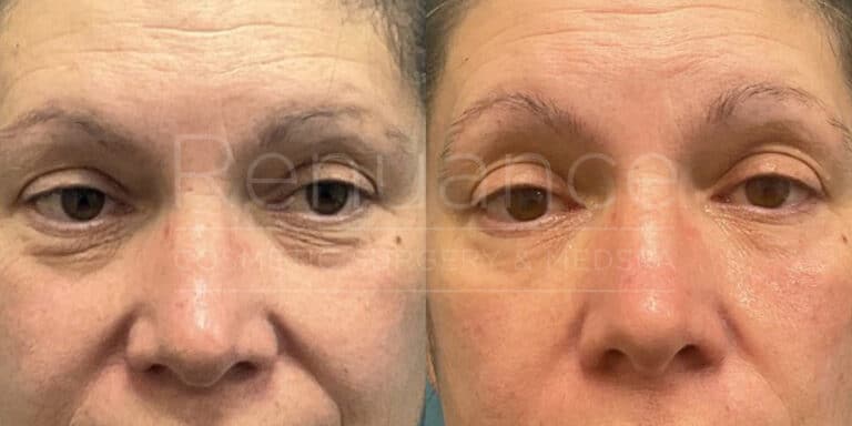 Renuance before and after | Under-eye filler by Chelsea Delaney, RN.