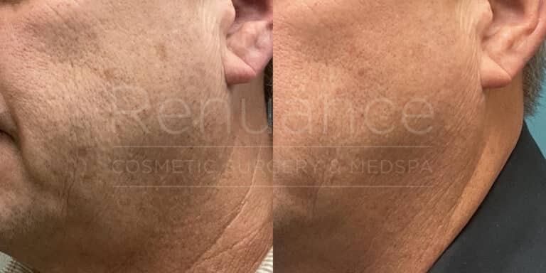 Renuance - Advalight before and after photo