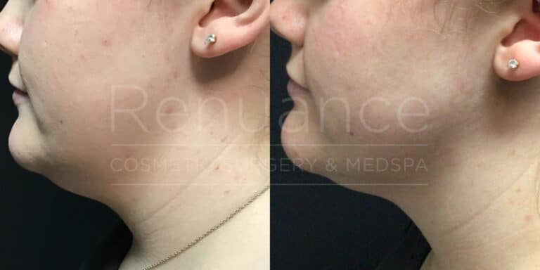 Renuance - Coolsculpting before and after photo