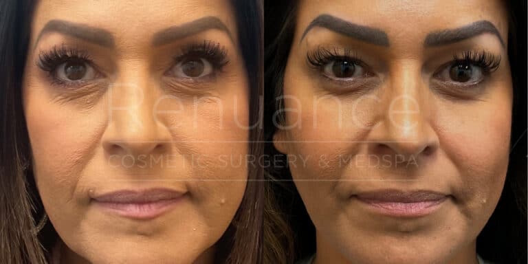 Renuance - Dermal Filler before and after photo