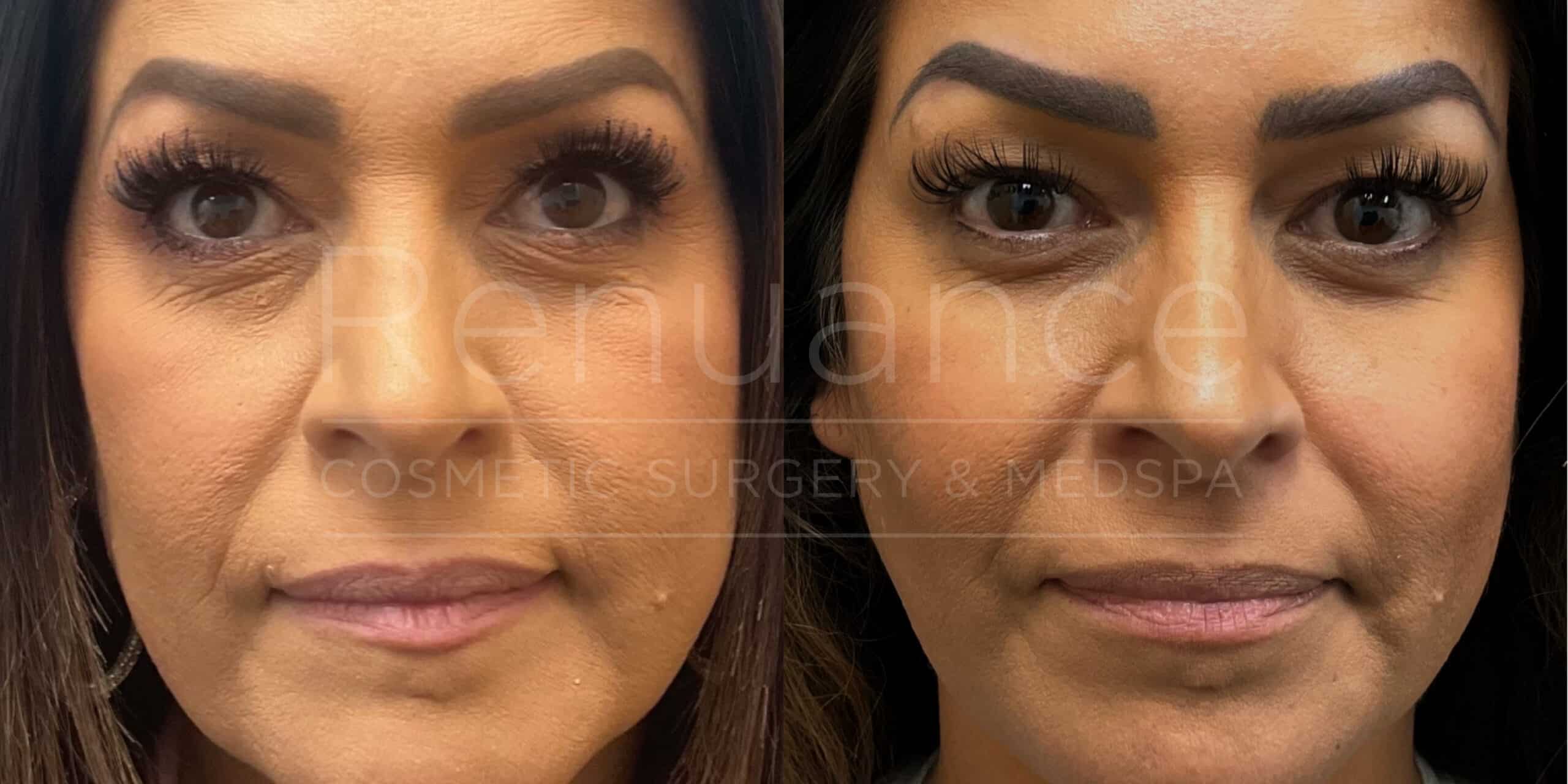 Renuance - Dermal Filler before and after photo