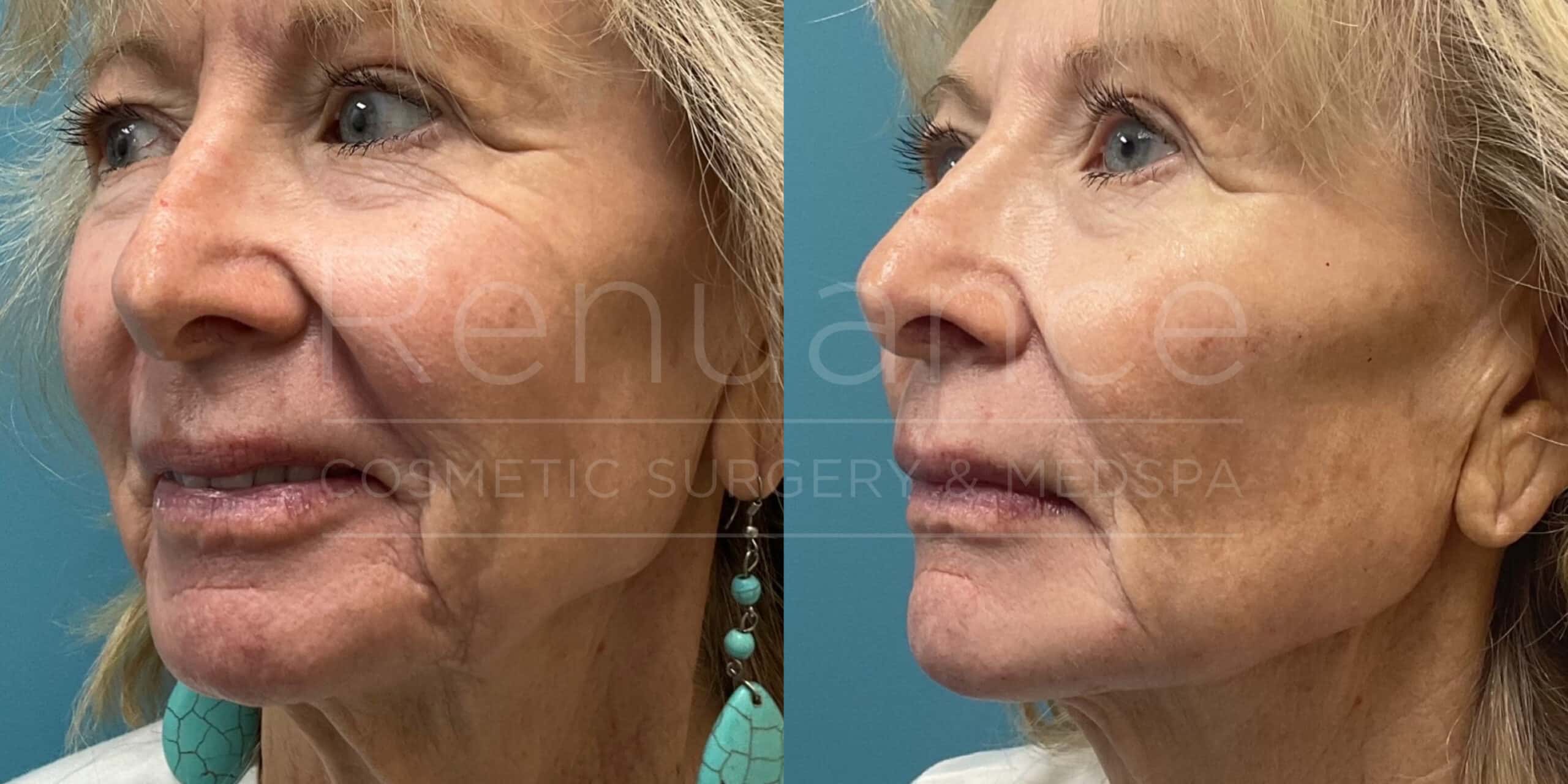 Renuance - Filler before and after photo - Angle 2