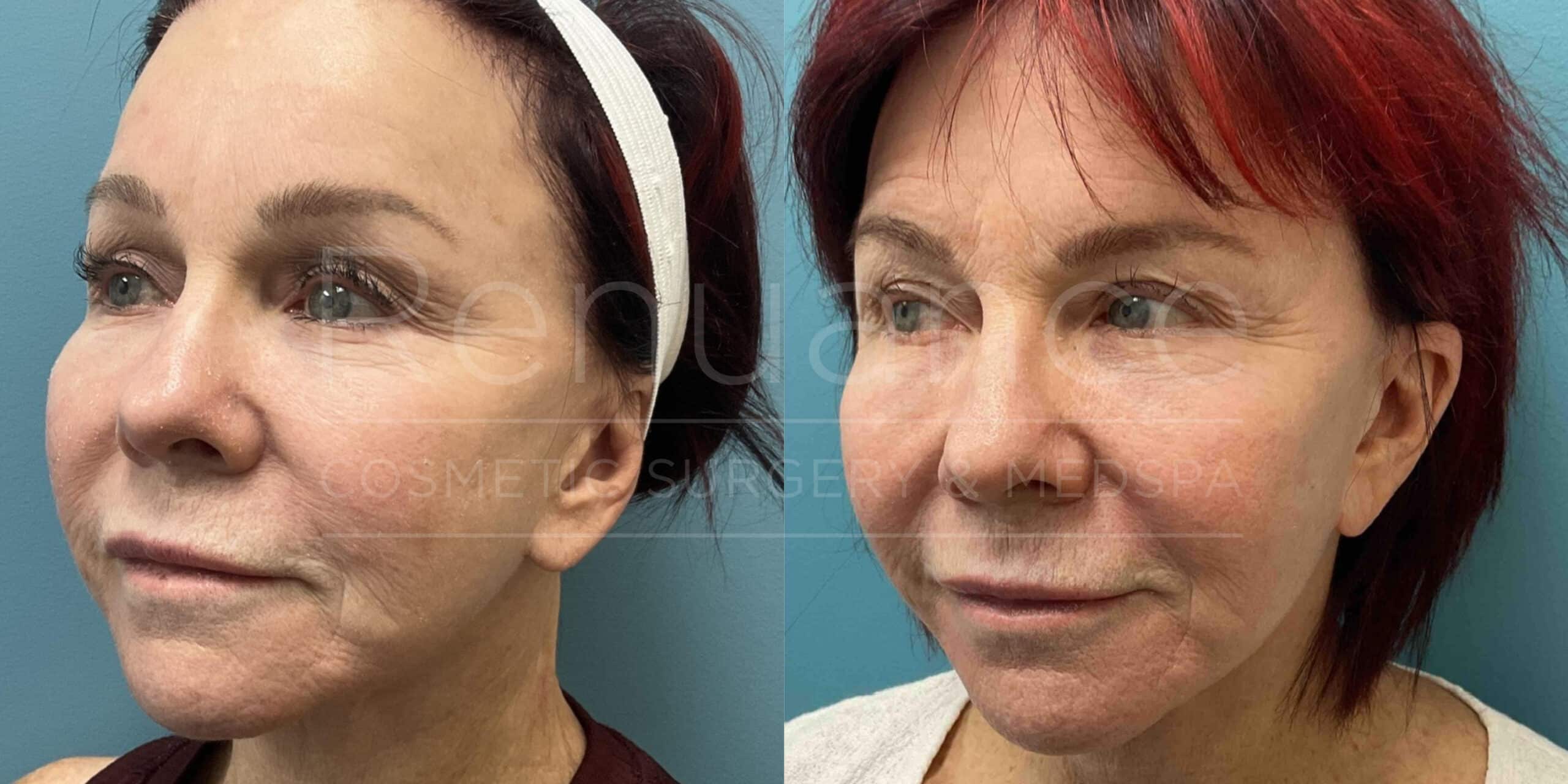 Renuance - Morpheus8 before and after photo - Angle 2