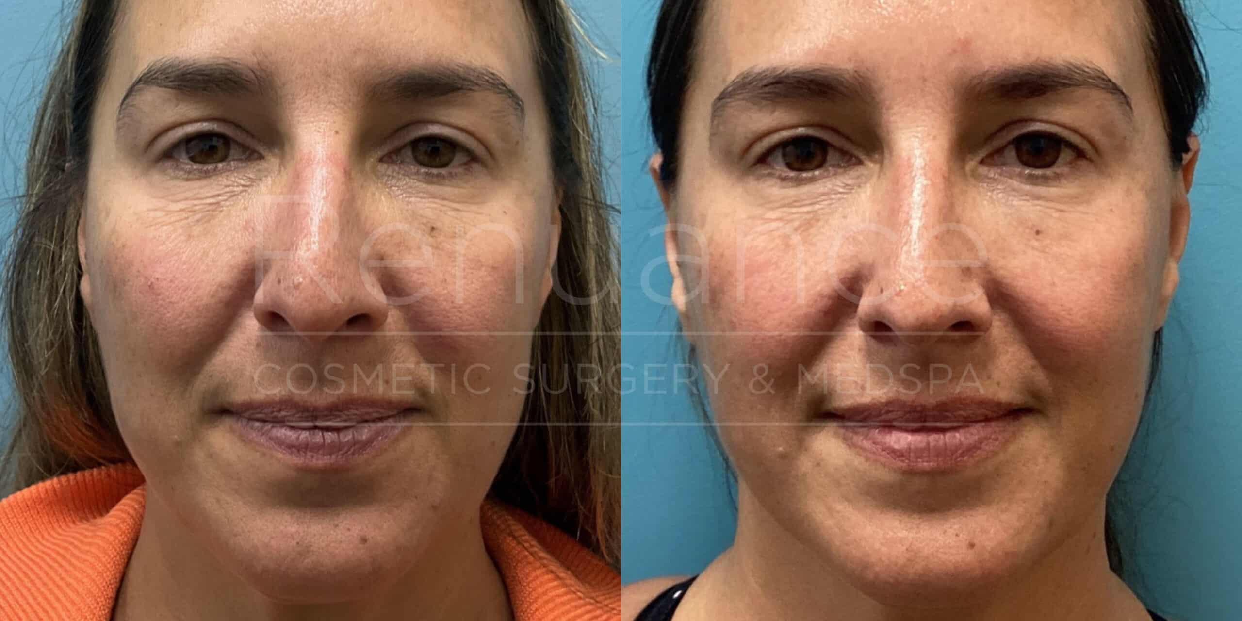 Renuance - Morpheus8 for the face and neck before and after photo