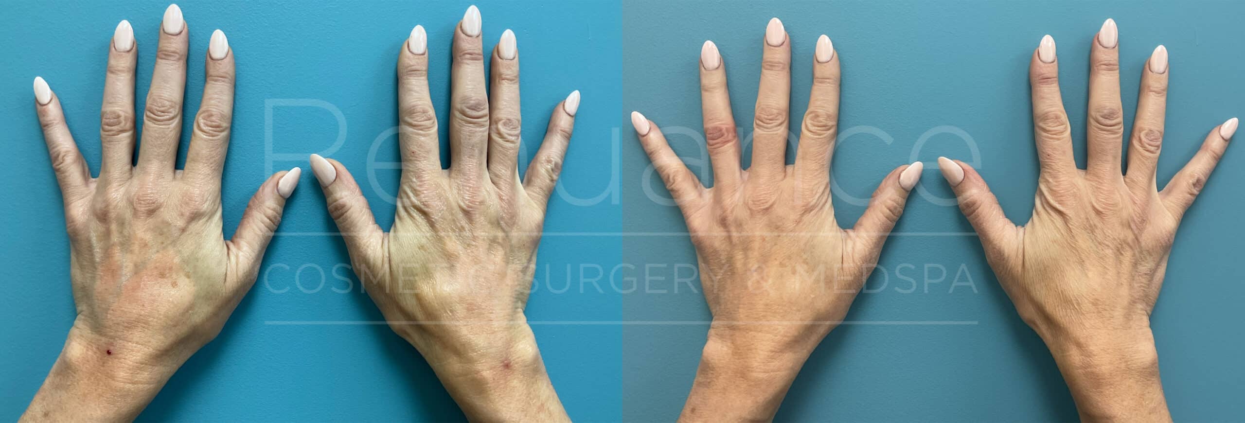 Renuance - Radiesse Hand Rejuvenation before and after photo