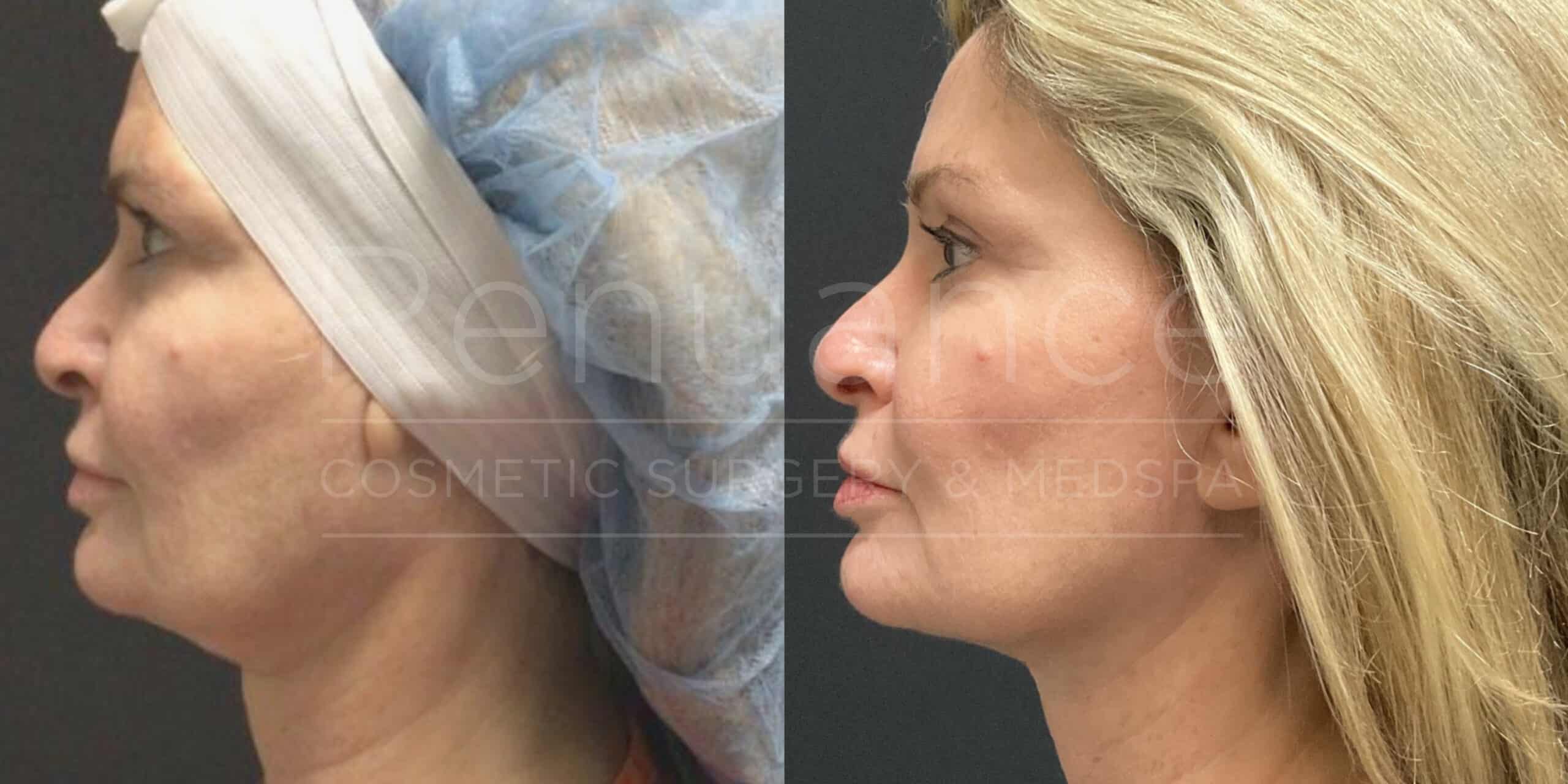 Renuance - Renuvion before and after photo - Angle 1